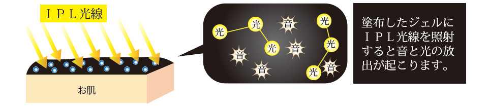 ブラックピーリングジェルを毛穴に塗布して光（IPL)照射することで、熱エネルギーがジェルの色素に反応し、毛穴の奥の細胞に熱を与え再生修復機能（創傷治癒）を促します。これにより毛穴の老廃物が除去されるだけでなく、肌内部の弾力繊維（コラーゲンなど）の生成が促進され、毛穴を引き締めます。頑固なニキビ・毛穴の詰まりや開きにしっかりと効果を実感していただけます。